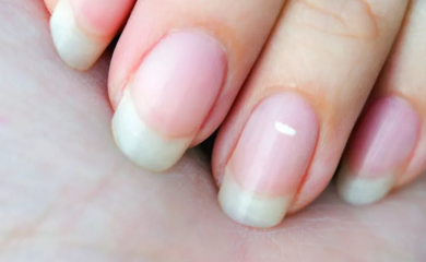 Da li bijele mrlje na noktima ukazuju na zdravstveni problem?