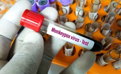 Panika zbog majmunskih boginja: Epidemiolog objašnjava koji su simptomi i kako se prenose
