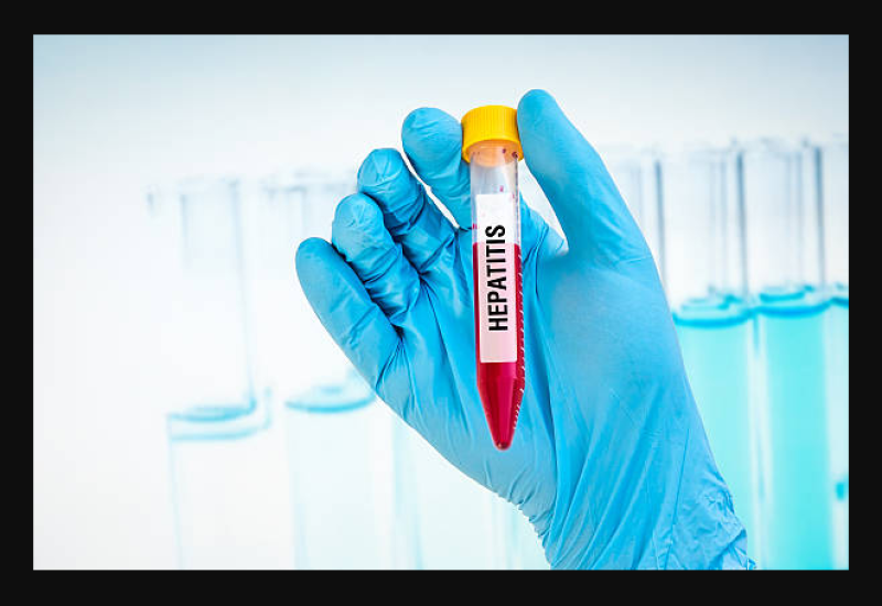 PODGORICA: Epidemija žutice i u oktobru